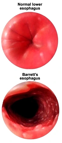 Barrett's esophagus causes , treatment ,symptoms