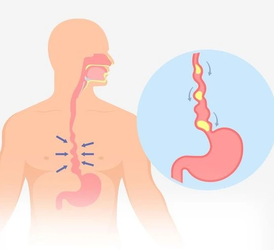 Esophageal Ulcer ? Causes,Symptoms,Treatment,Preventive Measures