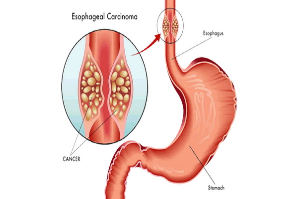 Esophageal Cancer ? Causes,Symptoms,Treatment,Preventive Measures