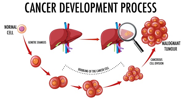 liver-cancer-process