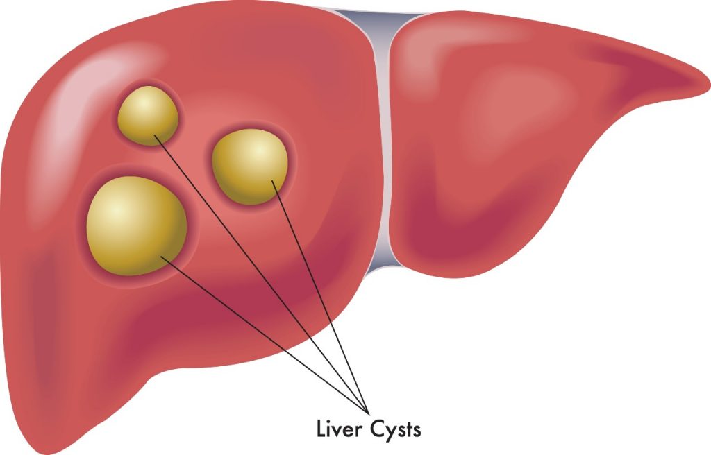 liver-cyst