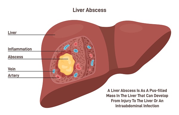 liver_abscess_25