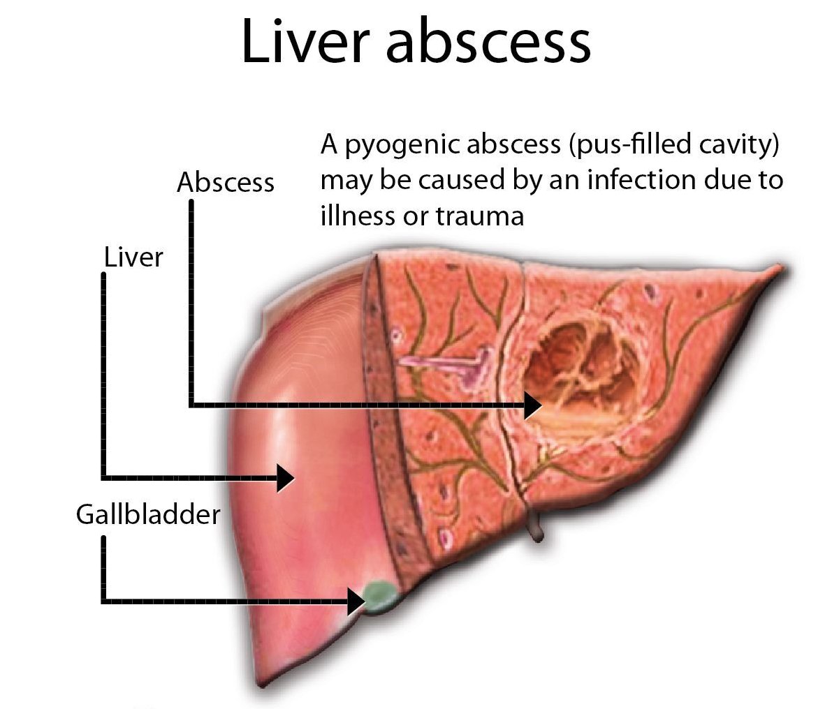 liverabscess