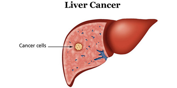 livercancer