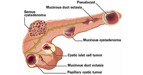 Pancreatic-Pseudocyst
