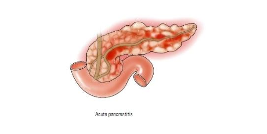 acute-pancrease