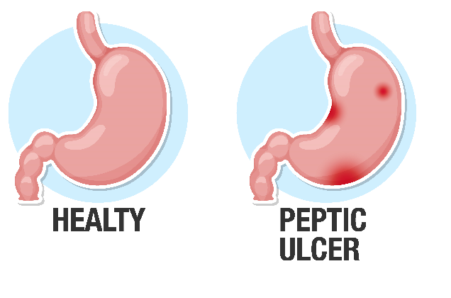 peptic-ulcer