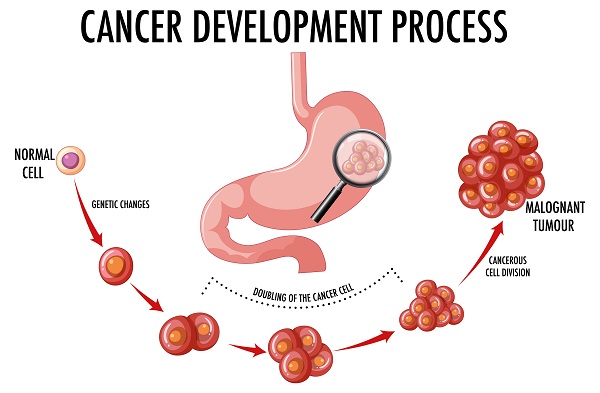 stomach-cancer-process