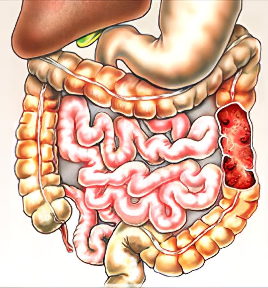 abdominal-TB
